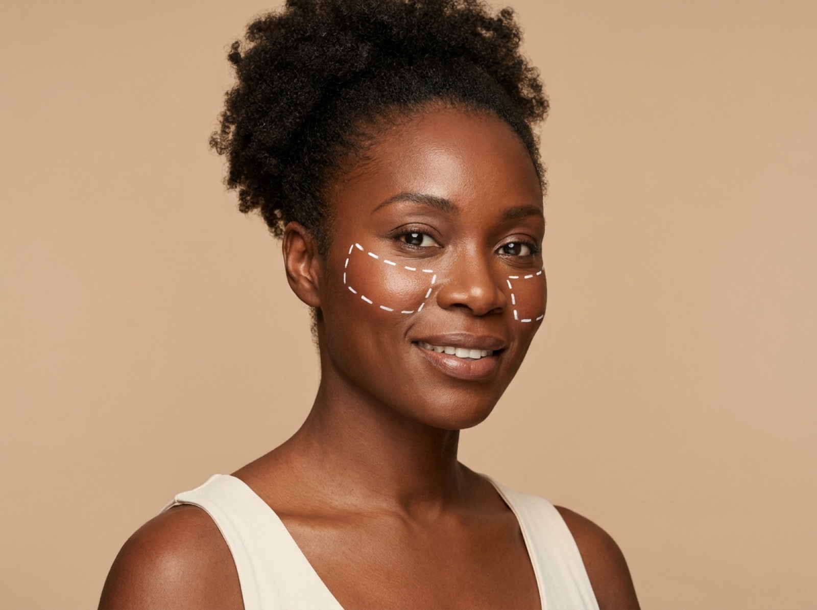 Derma Fillers – Cheeks