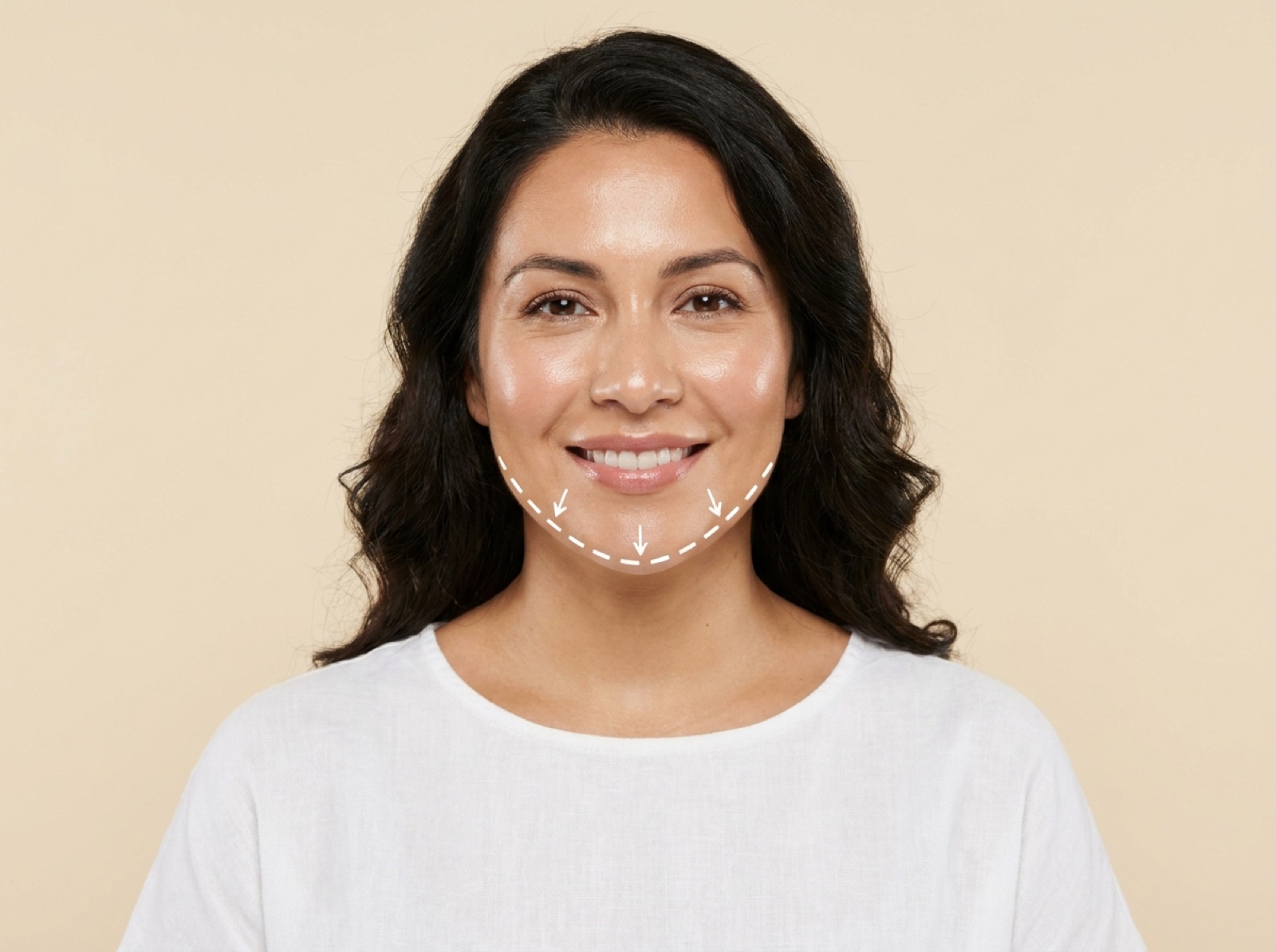 Derma Fillers – Chin