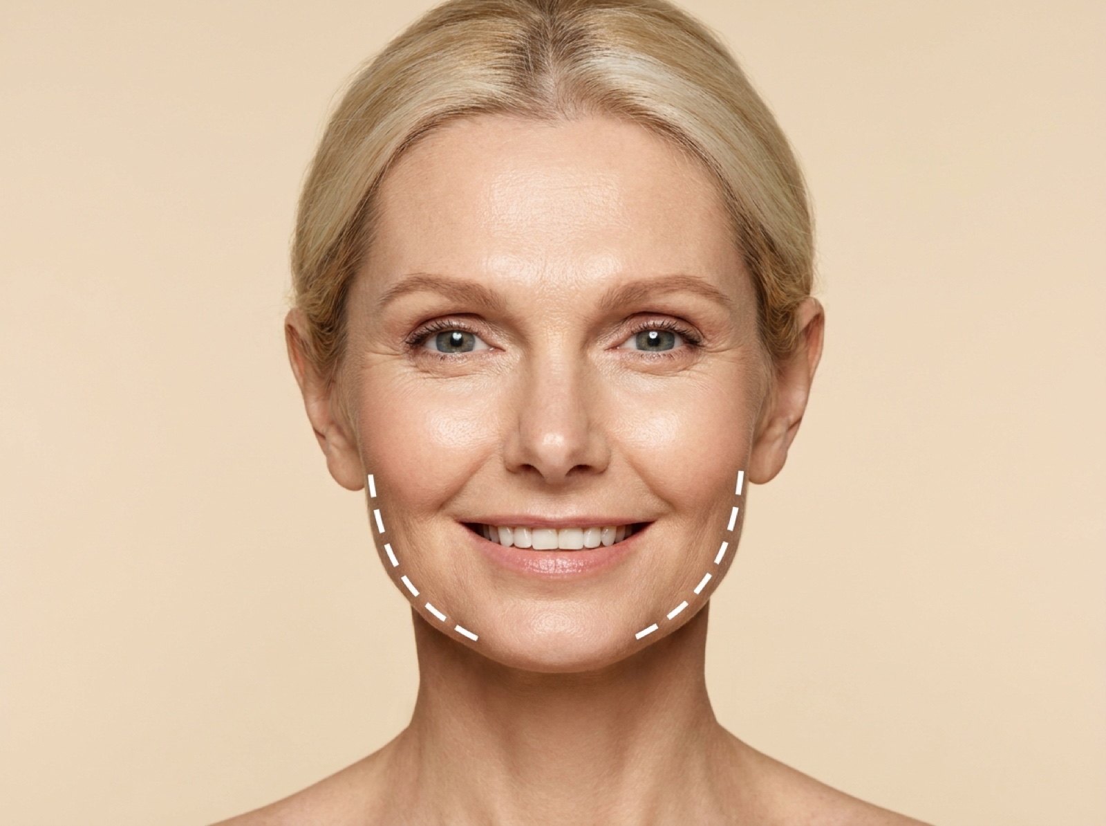 Derma Fillers – Jowls/Jawline