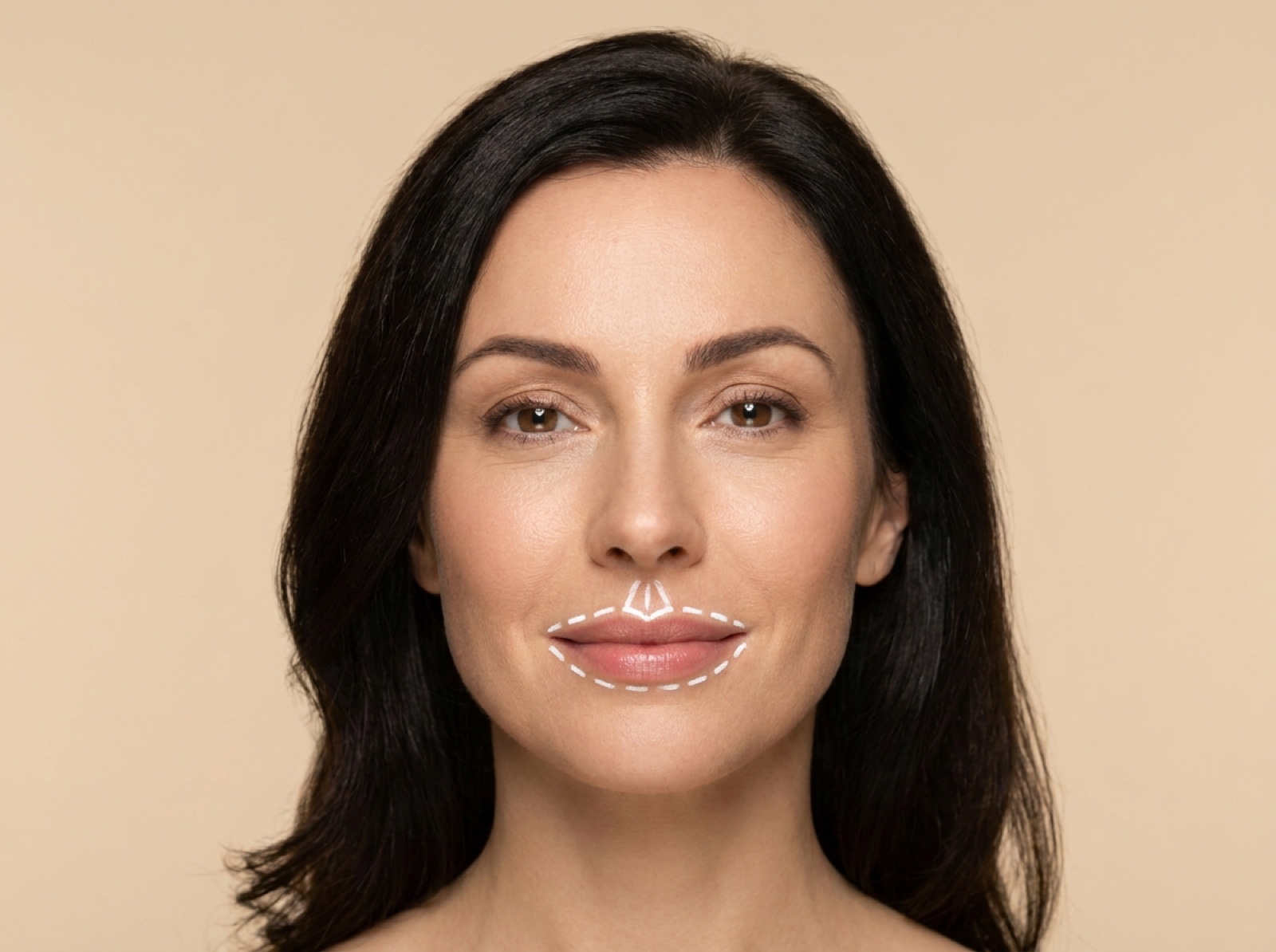 Botox / Dysport – Lip Flip