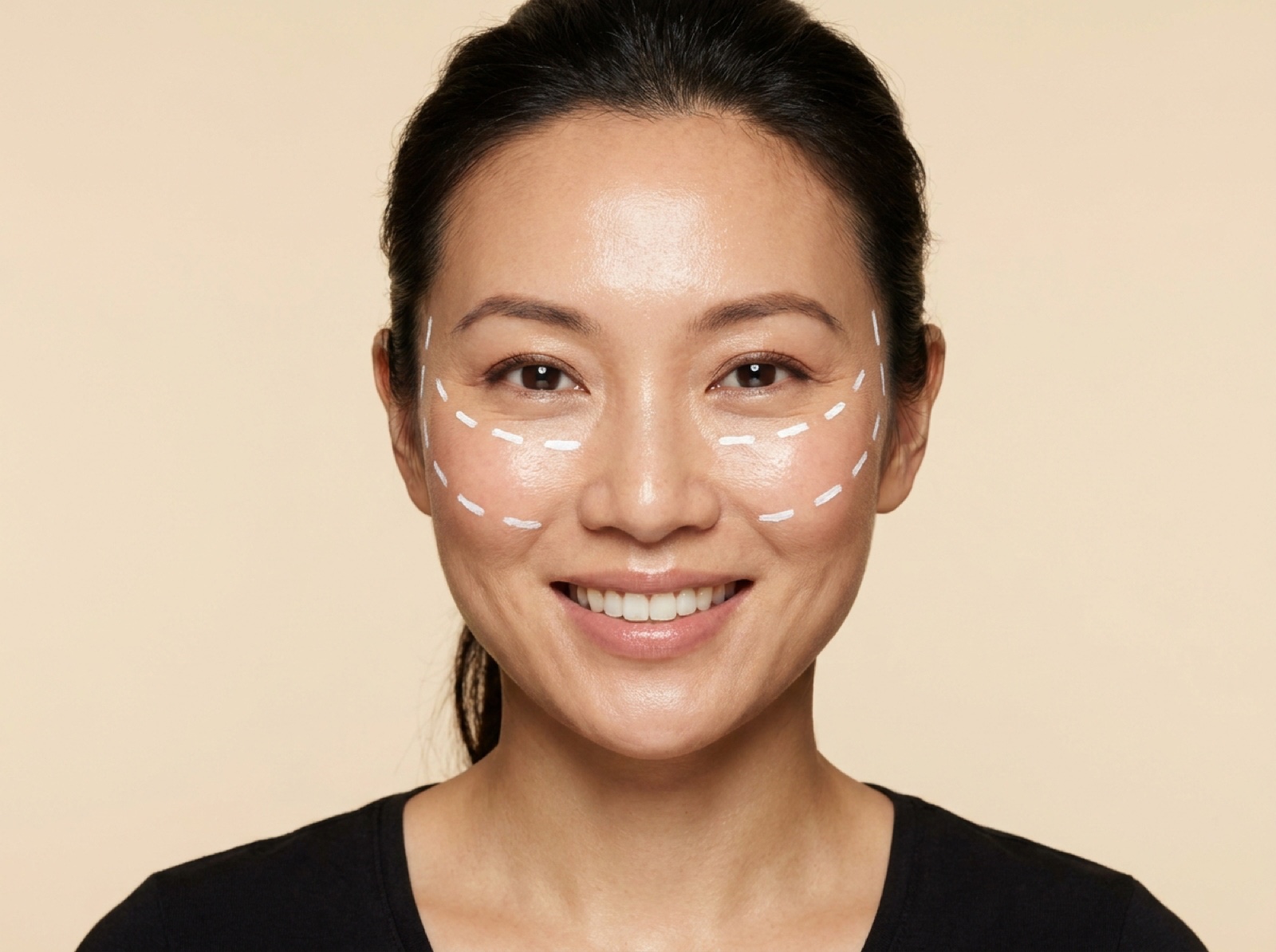Sculptra (face or body)