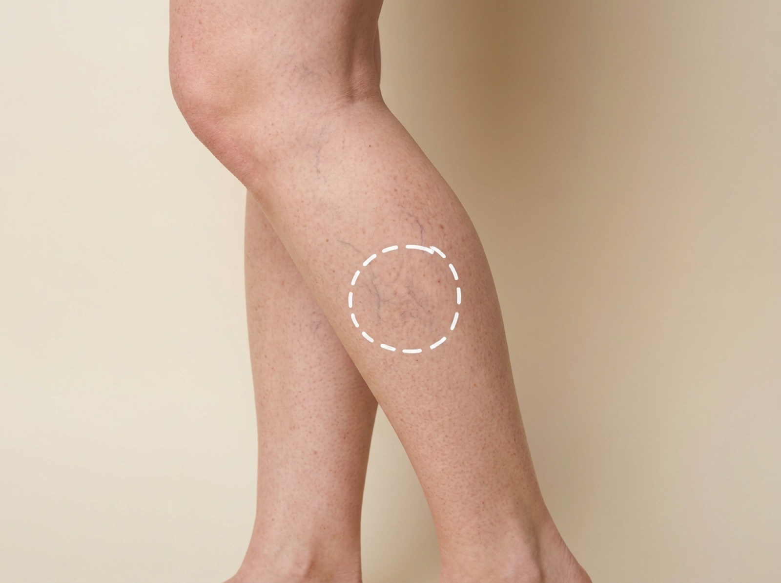 Vascular Lesions – Leg Veins Small Area